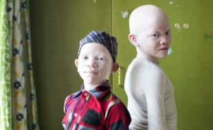 SOS-barnebyer driver en barneby i utkanten av Dar Es-Salaam, og her har et søskenpar med albinisme, storesøster Mela (9) og lillebror Abu (7), funnet et trygt hjem og god omsorg etter en tøff start på livet. Foto: Lars Just